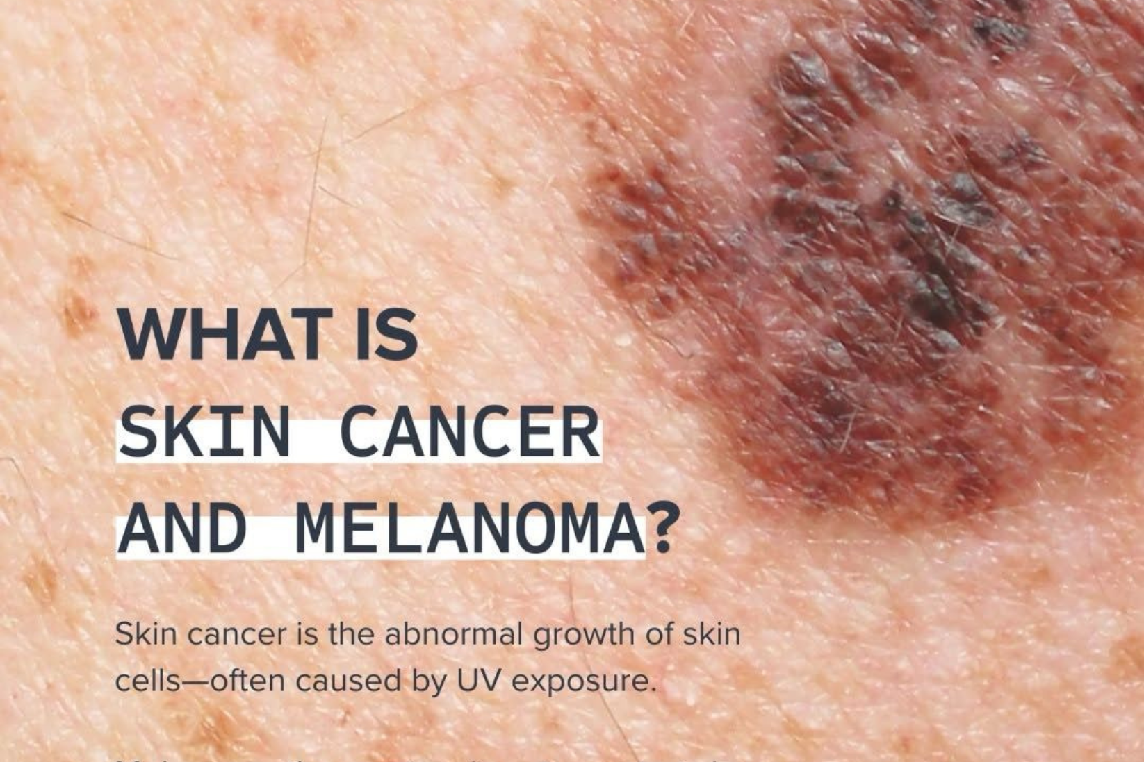 Skin Cancer